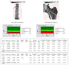 Sample Bone Density Results_Sydney